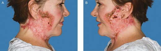 Improvement of facial lesions following 7 infusions of infliximab and local wound care. Photograph taken 1 year after the patient’s initial procedure. (A) Right. (B) Left. (February 21, 2020.)