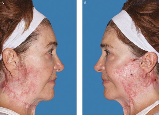 After resolution of her facial lesions the patient developed hypervascular, atrophic, and irregular scarring. Photograph taken 16 months after her initial procedure. (A) Right. (B) Left. (July 23, 2020.)