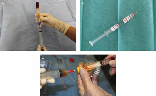 Illustration of different treatments prepared according to the manufacturer’s instructions. (A) a-PRP prepared with RegenKit-BCT-3, (B) SkinVisc (HA), and (C) a-PRP combined with HA prepared with Cellular Matrix BCT-HA. a-PRP, autologous platelet-rich plasma; HA, hyaluronic acid.