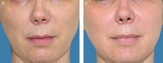 (A) A 47-year-old female patient before treatment with Cellular Matrix. (B) Six months posttreatment.