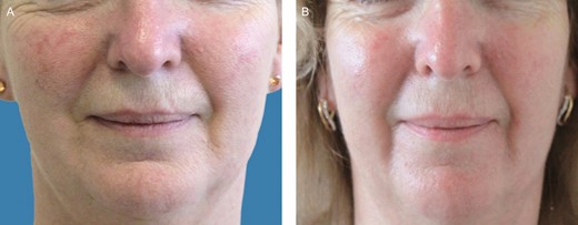 (A) A 55-year-old female patient before treatment with autologous platelet-rich plasma. (B) Six months posttreatment.