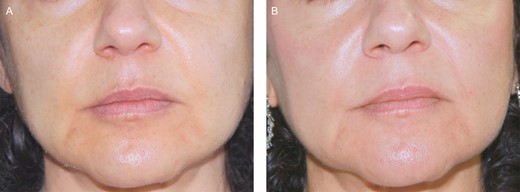 (A) A 51-year-old female patient before treatment with hyaluronic acid. (B) Six months posttreatment.