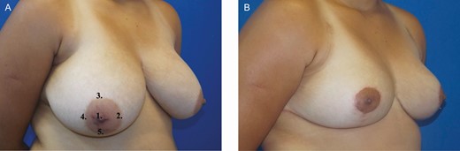 The right nipple-areola complex of a 22-year-old female. (A) Site of sensitivity assessment and the respective points. (B) Final aspect 1 year postoperative.