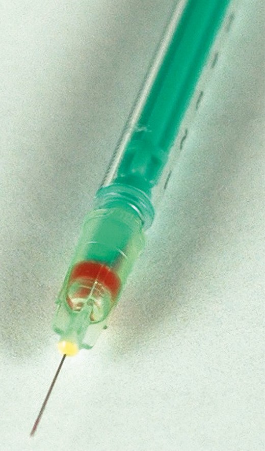 Blood backflow in 1-mL low-loss syringe with a 32-gauge needle from intra-arterial puncture.