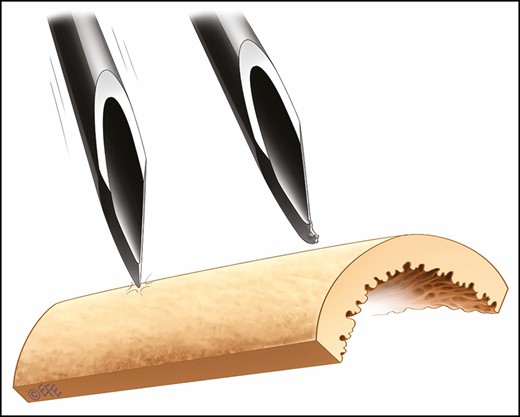 Needle in position abutting bone (the ultimate in remaining stationary) before aspiration. A needle tip may be altered (blunted or deformed) by this bony contact.