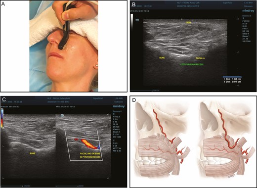 (A, B, C) Clinical and ultrasonic images of a deep aberrant artery in the deep pyriform recess. Usual vs aberrant facial artery patterns. (D) The aberrant pattern may position the facial artery in the nasolabial fold and upper cutaneous lip.