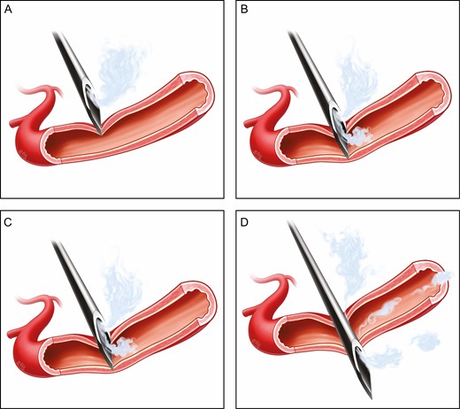 (A) Needle approaching vessel. (B) Needle impinging vessel. (C) Needle passing into vessel. (D) Needle passing through vessel depositing very little and probably not significant volume of product into the vessel.