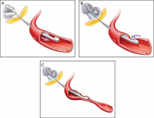 (A) Instrument has entered a vessel (here, a cannula is utilized for illustration). (B) Instrument is undergoing an aspiration maneuver but is sucking in the vessel wall, potentially producing a false negative aspiration test. (C) Instrument has entered the vessel, but with the pressure of aspiration the vessel wall may be collapsed, blocking the opening and again leading to a false-negative aspiration.