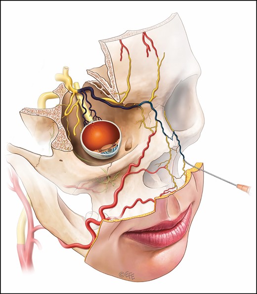 Injection of an artery (branch or trunk of the angular artery) will flow with the blood pressure of this vessel but must overcome the ophthalmic artery blood pressure to achieve access to the retinal and cerebral vasculature. This is most likely to require continued injection at sufficient pressure with a continuous bolus of material.
