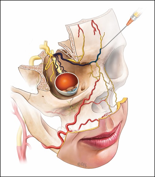 Given the proximate nature of the supratrochlear artery to the ophthalmic circulation, very little injection volume is required to reach the retinal vessels, making the injection of fillers near these ophthalmic artery branches much more dangerous than the branches of the external carotid arteries in the mid face and lower face.