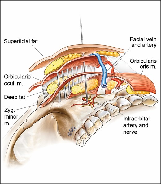 Vessels at foramina such as the infraorbital artery are relatively immobile and prone to injury from deep injection on the bone. This is true for all exiting vascular structures from facial foramina.