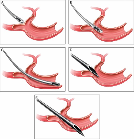 (A) Cannula approaching a fairly fixed point of vascular bifurcation. (B) Cannula piercing vascular bifurcation, entering vessel, and staying intravascular. (C) Cannula moving freely within the vessel, which may leave the practitioner unaware of its placement. (D) Needle entering vascular bifurcation. (E) Unlike the cannula, a needle is likely with movement to exit the vessel.
