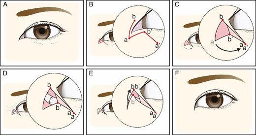 Schematic illustration of surgical technique. (A) Overcorrected medial epicanthus requiring revision medial epicanthoplasty. (B) Point (a) was marked at the existing location of medial canthus. Point (b) was an imaginary spot considered the desired medial canthus point. A curvilinear line was drawn from (a) to (b) as a continuous smooth arc. Point (a’) was marked near the area where the medial edge of canthal tendon was projected. Point (b’) was defined as a surface representation of the most medial point of lacrimal lake. These points were adjusted as required by severity of prior surgical scars. (C) A skin incision was created along the line b-a-b’, and the triangular flap was flipped over b-a-b’ and was anchored to point (a’). (D) Then subcutaneous dissection was performed, undermining the medial area, and residual scar tissue was removed as necessary. Medial canthal tendon and orbicularis oculi muscle were then exposed, utilizing 6-0 Vicryl suture to reposition/realign damaged muscle and canthus. (E) On completion, the skin was closed. (F) Three-dimensionally restored medial epicanthus.