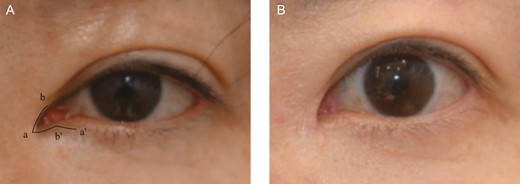 This 46-year-old female patient received the 3-dimensional restoration of medial epicanthus employing the reverse Z-plasty technique. (A) Preoperative photograph with view design and (B) 6-month postoperative view.