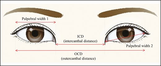 Schematic presentation of interepicanthal distance (ICD), outer canthal distance (OCD), and palpebral width.