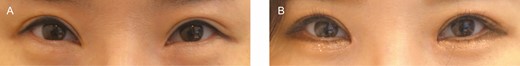 (A) Preoperative view and (B) 12-month postoperative view of this 27-year-old female patient.
