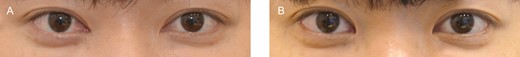 (A) Preoperative view and (B) 12-month postoperative view of this 27-year-old male patient.