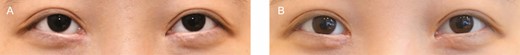 (A) Preoperative view and (B) 12-month postoperative view of this 35-year-old female patient.