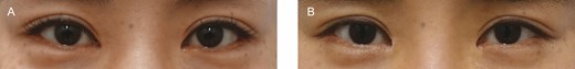 (A) Preoperative view and (B) 12-month postoperative view of this 29-year-old female patient.