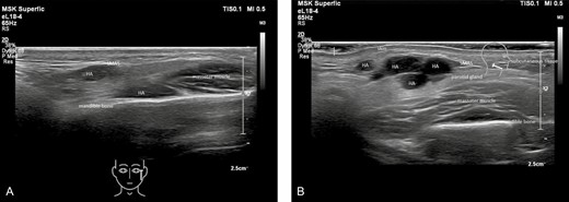 (A, B) Ultrasound images showing nodules in the parotid gland. HA, hyaluronic acid filler; SMAS, superficial musculo-aponeurotic system.