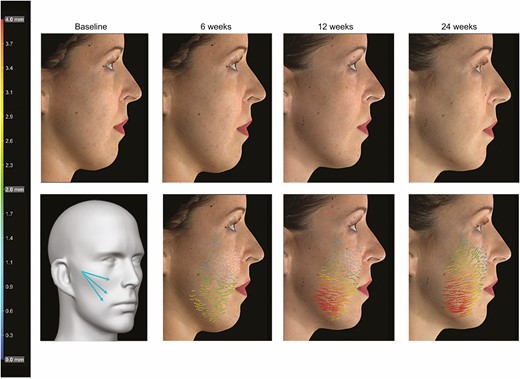 Markerless tracking analysis featuring this 36-year-old female patient needing midface skin tightening and treated with 3 Barb II (needle 23G/60 mm) polydioxanone sutures on right upper cheek. Photographs show the patient at baseline and 6, 12, and 24 weeks after implantation. Suture implantation pattern (printed with permission from Croma-Pharma GmbH), analysis of skin movements, and vectors indicate intensity (see color scale) and direction of skin displacement (Figures 4-6) or major strain (Figure 7) compared with the baseline pretreatment photograph.