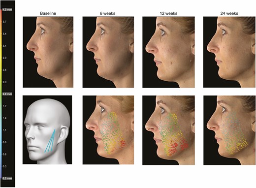 Markerless tracking analysis featuring this 41-year-old female patient presenting with a mild sagging tissue and treated with 3 Barb II (needle 21G/90 mm) polydioxanone sutures on left lower cheek. Photographs show the patient at baseline and 6, 12, and 24 weeks after implantation. Suture implantation pattern (with permission of Croma-Pharma GmbH), analysis of skin movements, and vectors indicate intensity (see color scale) and direction of skin displacement (Figures 4-6) or major strain (Figure 7) compared with the baseline pretreatment photograph.