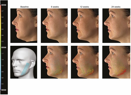 Markerless tracking analysis featuring this 50-year-old female patient showing sagging jawline and treated with 3 Barb II (cannula 19G/90 mm) polydioxanone sutures on left lower jowl. Photographs show the patient at baseline and 6, 12, and 24 weeks after implantation. Suture implantation pattern (with permission of Croma-Pharma GmbH), analysis of skin movements, and vectors indicate intensity (see color scale) and direction of skin displacement (Figures 4-6) or major strain (Figure 7) compared with the baseline pretreatment photograph.