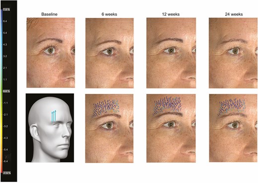 Markerless tracking analysis featuring this 39-year-old female patient presenting with mild sagging lateral eyebrows and treated with 3 Barb II (needle 23G/60 mm) polydioxanone sutures on the right brow. Photographs show the patient at baseline and 6, 12, and 24 weeks after implantation. Suture implantation pattern (with permission of Croma-Pharma GmbH), analysis of skin movements, and vectors indicate intensity (see color scale) and direction of skin displacement (Figures 4-6) or major strain (Figure 7) compared with the baseline pretreatment photograph.