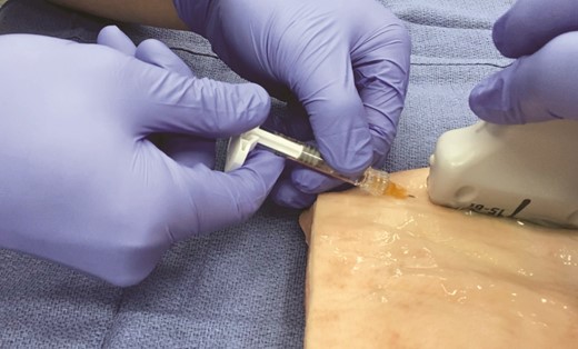 Double-handed aspiration test. The nondominant hand is used to stabilize the syringe while the dominant hand performs the aspiration test.