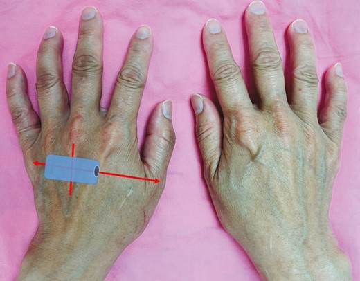 Illustration of sonographic transducer positioning on the dorsum of the hand in a 40-year-old female patient. The aging dorsal hands show visible extensor tendons and bulging veins.