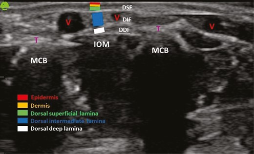Anatomic structures of the dorsum of the hand through ultrasound examination. DDF, dorsal deep fascia; DIF, dorsal intermediate fascia; DSF, dorsal superficial fascia; IOM, interosseous muscle; MCB, metacarpal bone; T, extensor tendon; V, vein.
