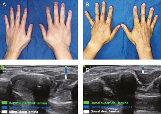 (A) Youthful appearance of the dorsum of the hand in a 23-year-old male showing supple soft tissues obscuring the subcutaneous structures. (B) Aged appearance of the dorsum of the hand in a 48-year-old male showing dominant wrinkles, prominent tendons, bulging veins, and volumetric loss in the sunken thenar and hypothenar eminence. (C) Ultrasound examination of the dorsum of the hand in a 23-year-old male patient. (D) Ultrasound examination of the dorsum of the hand in a 48-year-old male patient, showing volumetric loss in the 3 fatty laminae, especially the dorsal intermediate lamina.