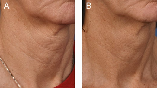 A 56-year-old female at (A) baseline and (B) 3 months after the last microneedling procedure.