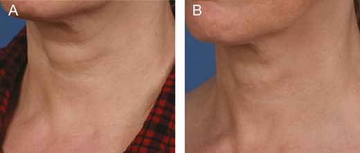 A 48-year-old female at (A) baseline and (B) 3 months after the last microneedling procedure.