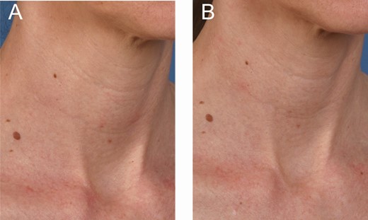 A 44-year-old female at (A) baseline and (B) 3 months after the last microneedling procedure.