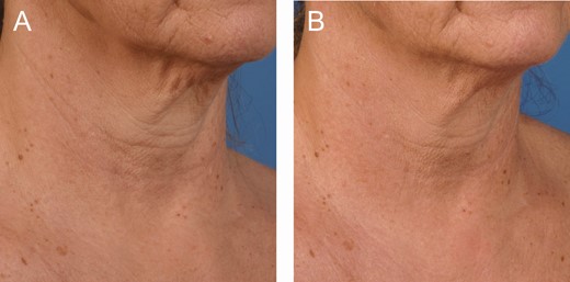 A 56-year-old female at (A) baseline and (B) 3 months after the last microneedling procedure.