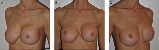 Preoperative clinical photographs of a 54-year-old female patient who presented with right-sided implant failure, symmastia, and a bilaterally irregular inframammary fold: (A) left oblique view, (B) frontal view, and (C) right oblique view. The patient’s intraoperative photographs can be seen in Figures 3 and 4.