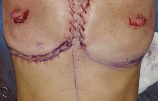 Intraoperative photographs of the 54-year-old female patient seen in Figure 2. The patient underwent capsulectomy and reinforcement of the ideal breast footprint with net sutures, before reshaping of the breast pocket with internal sutures and replacement of her breast implants bilaterally. The hemostatic net is seen in situ over the medial, inferior, and lateral aspects of the right breast pocket prior to implant insertion, with the commencement of the net placement on the left side being demonstrated.