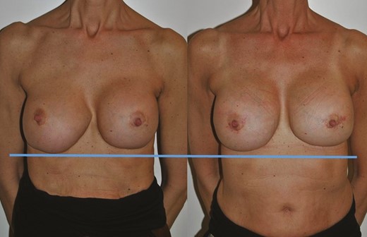 Preoperative (left) and 1-year postoperative (right) clinical photographs of the 54-year-old female patient seen in Figure 2. Although a mild asymmetry is still present, the preoperative difference between the 2 breasts has been improved, especially regarding the roundness and smoothness of the right inferior pole. The horizontal blue line demonstrates the elevation of the right inframammary fold achieved by the intentional overcorrection demonstrated in Figure 4.