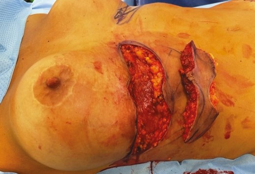 Intraoperative clinical photographs of the 46-year-old female patient in Figure 7. The upper abdominal flap was undermined, elevated, contoured, and advanced into the new inframammary fold.