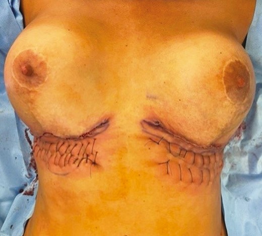 Intraoperative clinical photographs of the 46-year-old female patient in Figure 7. The hemostatic net is demonstrated stabilizing the inframammary folds and securing the upper abdominal flap in situ fixed to the underlying deep fascia.