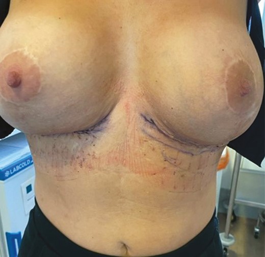 A 3-month postoperative result of the 46-year-old female patient in Figure 7. At this early follow-up a good improvement of the upper abdominal skin laxity is demonstrated with additional benefits to the glandular ptosis of the breasts evident in the preoperative photographs (Figure 7). The hemostatic net has provided a stable base and support for the reverse abdominoplasty.