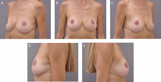 Preoperative clinical photographs of a 40-year-old female patient who presented with a combination of high-riding nipples and pseudoptosis having previously undergone a reduction mammaplasty elsewhere: (A) left oblique view, (B) frontal view, (C) right oblique view, (D) left lateral view, and (E) right lateral view. She sought an increase in volume, particularly in the upper poles, as well as correction of the suboptimal aesthetics of her breast. This patient underwent a lower pole mastopexy augmentation combined with the use of the hemostatic net to stabilize and recontour the lower pole of the breast, raise and support the inframmamary crease, and in effect, undergo a reverse abdominoplasty to lift the thoraco-epigastric skin more cranially. (See main text for further details.).