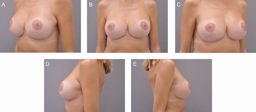 One-year postoperative clinical photographs of the 40-year-old female patient seen in Figure 11: (A) left oblique view, (B) frontal view, (C) right oblique view, (D) left lateral view, and (E) right lateral view. Much improved overall proportions of her breasts can be appreciated with the nipple-areola complex more appropriately sited on the breast mound. Despite a relatively large implant being placed into an uncertain soft tissue environment, the hemostatic net has provided stability to the IMF and cranial advancement of the thoraco-epigastric skin.