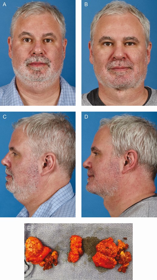 (A, C) Preoperative views of a 48-year-old male patient with cervical fullness and blunting of the mandibular border attributed to large and ptotic submandibular glands, subplatysmal fat, and digastric hypertrophy. (B, D) Four-month postoperative views following anterior open neck lift with deep neck work including submandibular gland and subplatysmal fat excision with a digastric shave. (E) Bilateral submandibular glands (a), subplatysmal fat (b, lateral; c, central), and digastric muscle (d) resected from the same patient.