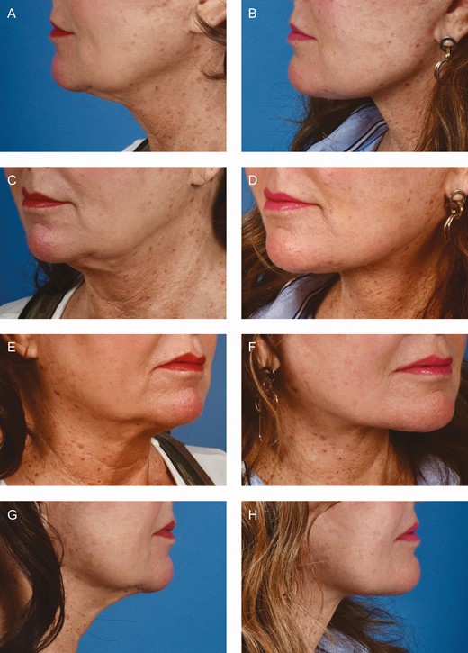 (A, C, E, G) Preoperative views of a 71-year-old female patient with persistent submandibular fullness after a previous facelift with anterior open neck platysmaplasty. (B, D, F, H) Three-month postoperative views following secondary facelift and neck lift with primary submandibular gland reduction.