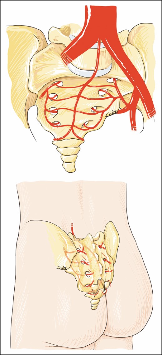 Parasacral artery perforator pathway: anterior and posterior view.
