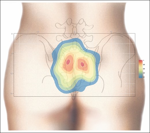 Heat map generated from the contour plot analysis for PSAP density. Two regions with a higher PSAP density (orange-red) are clearly shown. Right, scale with PSAP per cm2. PSAP, parasacral artery perforator.