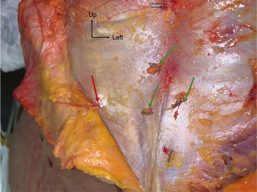 Dissection of PSAPs on a suprafascial plane for a 69-year-old female patient. Red arrow, PSAP with a vertical course; green arrows, other PSAPs clipped for location. PSAP, parasacral artery perforator.