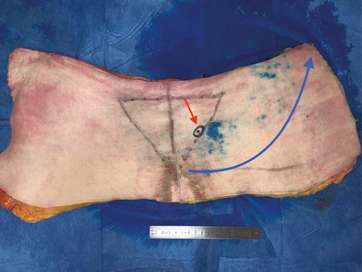 Study of the cutaneous vascularization of parasacral artery perforators after injection with methylene blue for an 80-year-old male patient. Red arrow, location of the catheterized perforator; blue arrow, flow orientation.